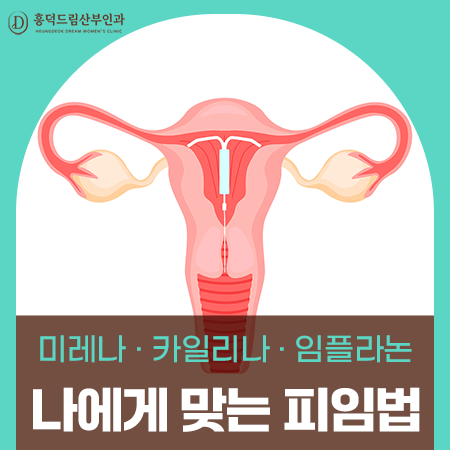 피임 시술, 미레나·카일리나·임플라논 중 무엇을 기준으로 골라야 하나요?