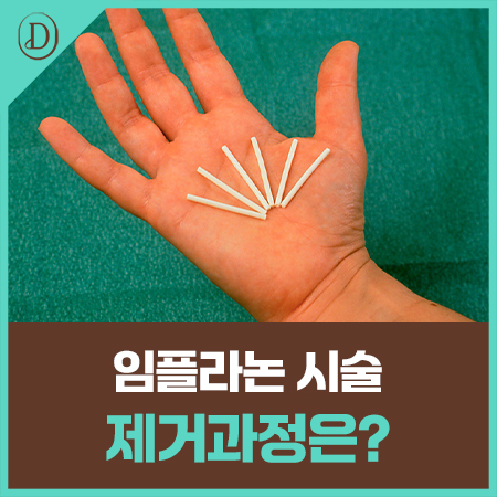 임플라논 시술 통증, 제거 후 임신은 언제부터 가능할까요?